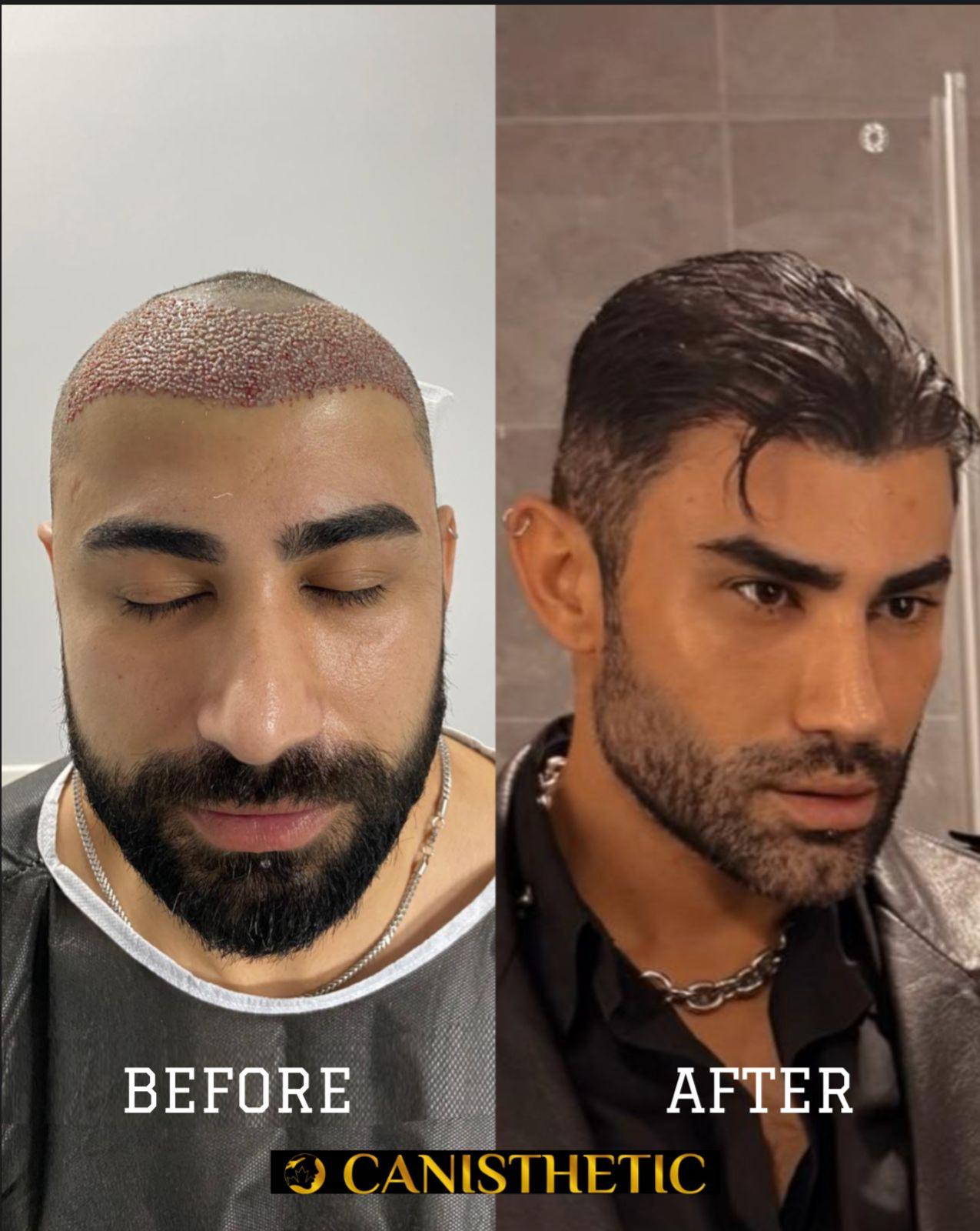 Hair transplant before and after — Case 1